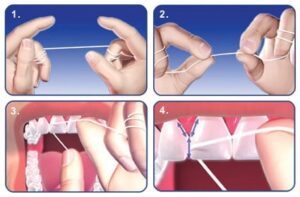 Brushing and Flossing - Dental Solutions Tauranga