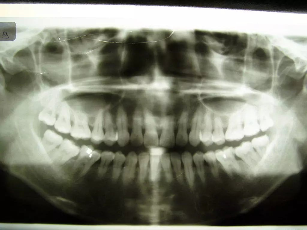 Panoramic X-Rays - Dental Solutions Tauranga
