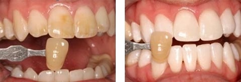 Teeth Whitening - Deep Bleaching