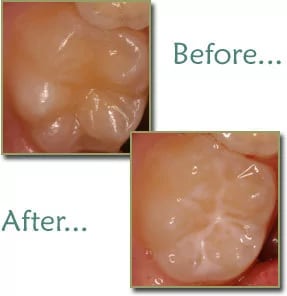 Fissure Sealant