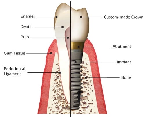 Dental Implant